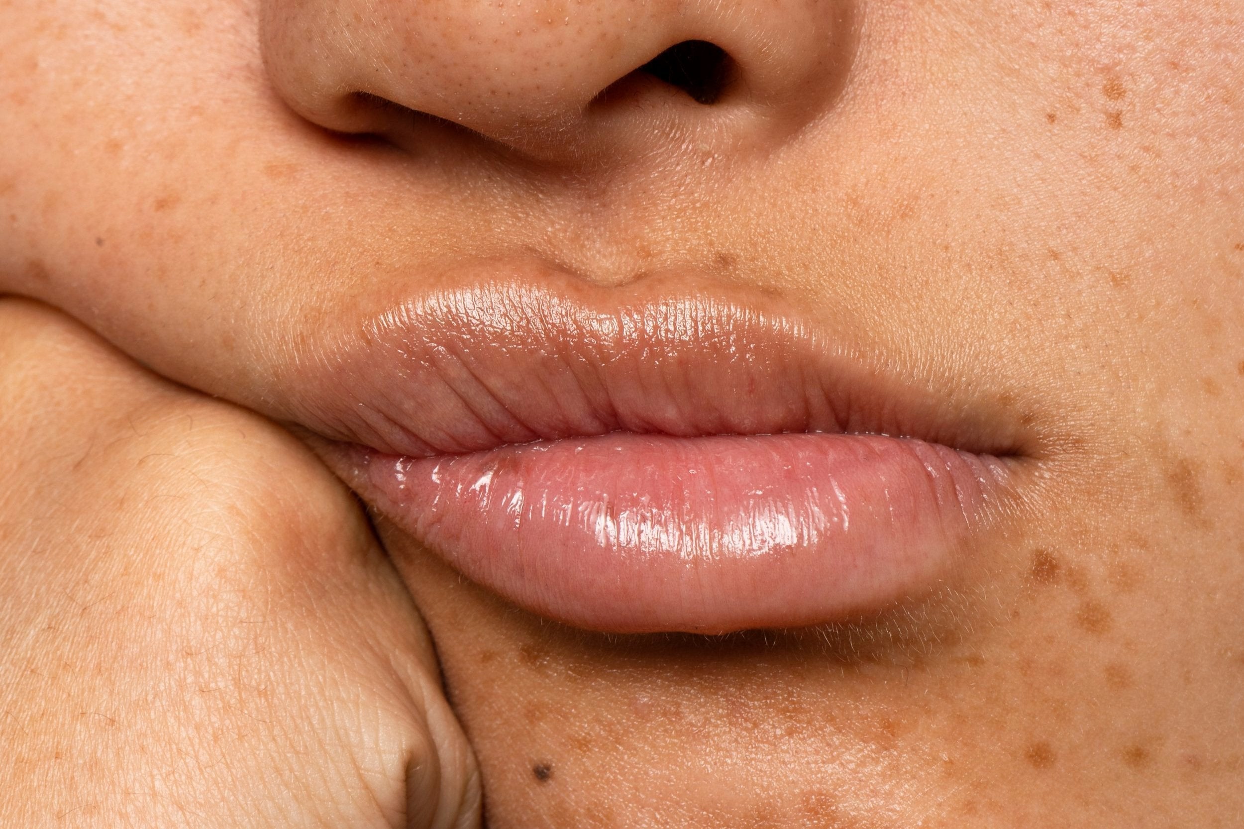 What is Hyperpigmentation and How to Target It